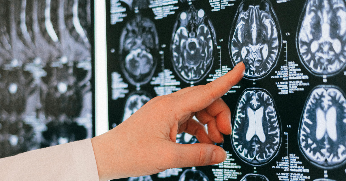 AI Project Extended to Enhance Predictions for Drug-Resistant Epilepsy