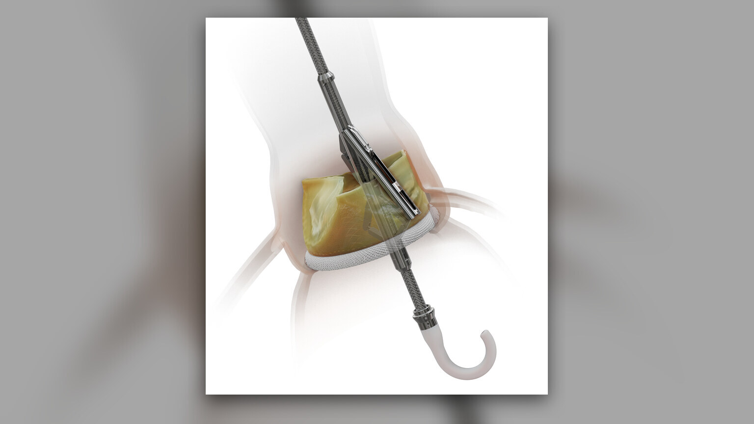 Medtronic Invests Up to $80 Million in Pi-Cardia